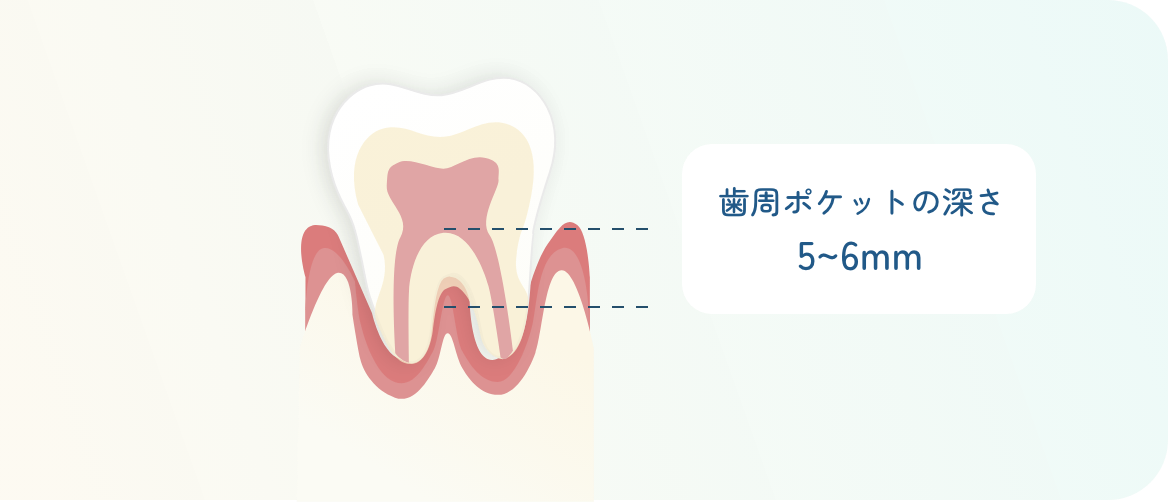 歯周ポケットの深さ5〜6mmの中等度の歯周病のイラスト