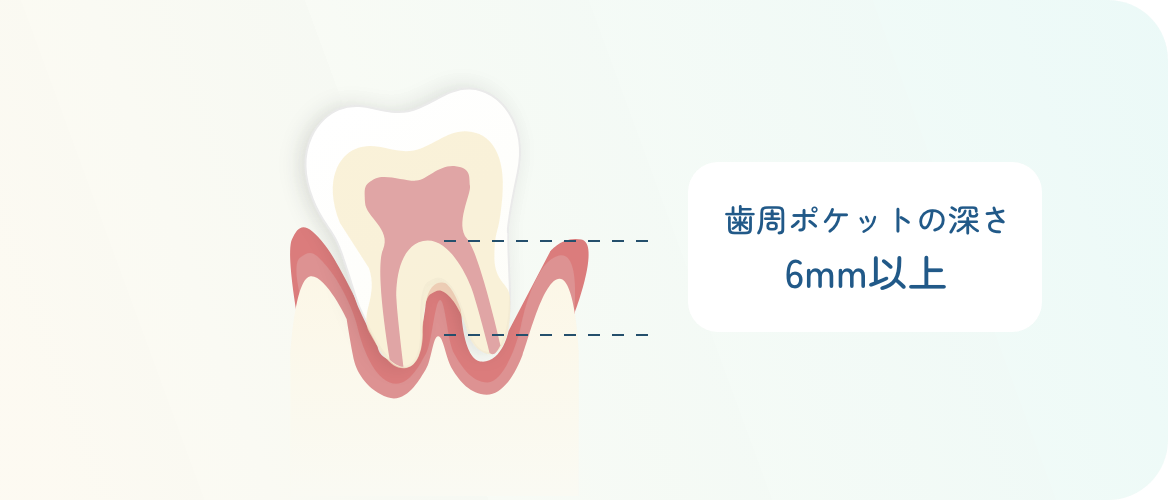 歯周ポケットの深さ6mm以上の重度歯周病のイラスト